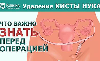Удаление кисты Нука: что важно знать перед операцией