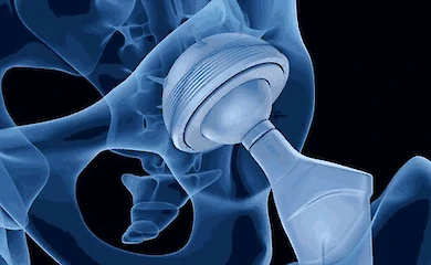 Обуховская многопрофильная больница планирует приобрести 35 комплектов эндопротезов