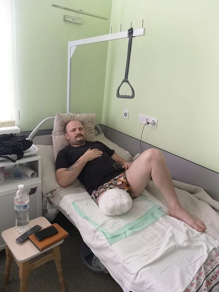 Ветеран АТО з Обухова втратив ногу: йому терміново потрібен протез