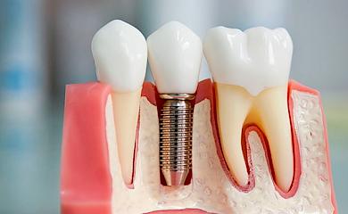 Наращивание костной ткани: цена, показания, преимущества